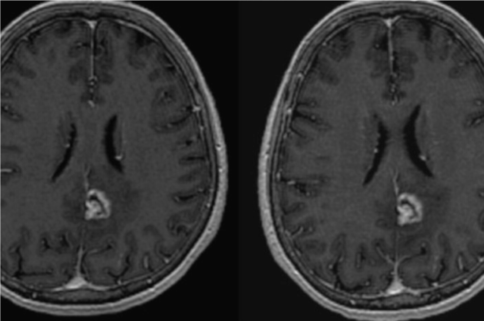 MRI of brains